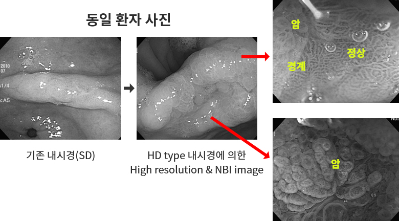 위점막 절제술의 예