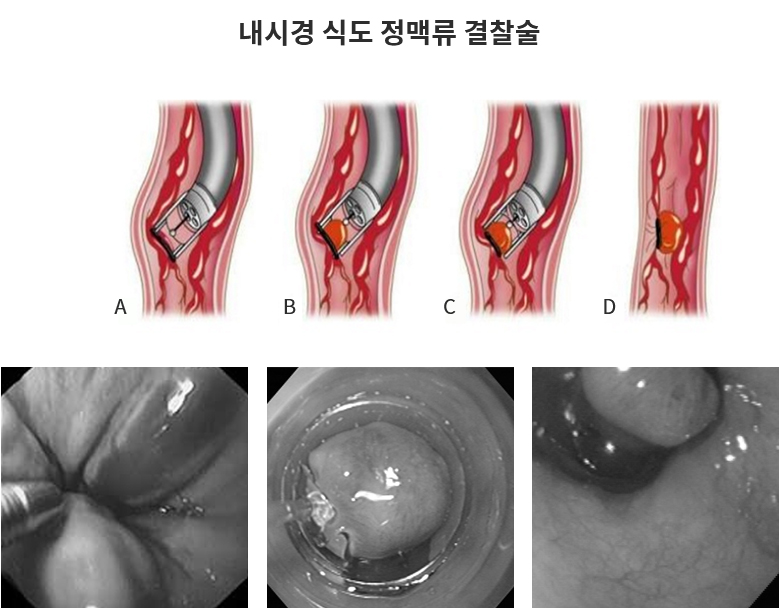 내시경 식도 정맥류 결찰술