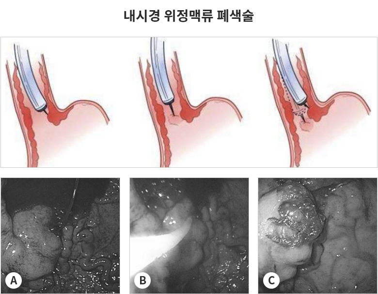 내시경 위정맥류 폐색술